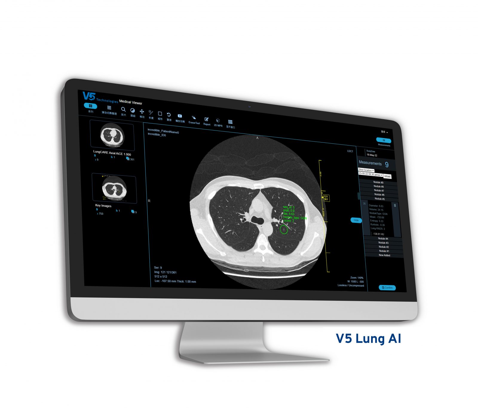 V5med Lung AI - Công cụ hỗ trợ chẩn đoán đạt chuẩn lâm sàng